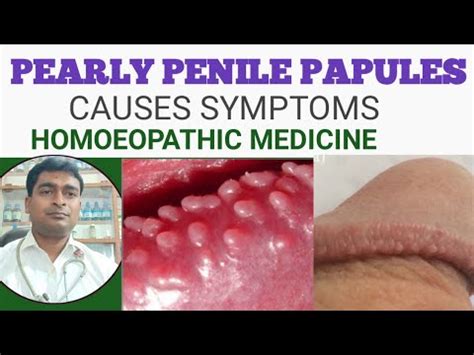 papule penienne|Diagnosis and Management of Pearly Penile Papules